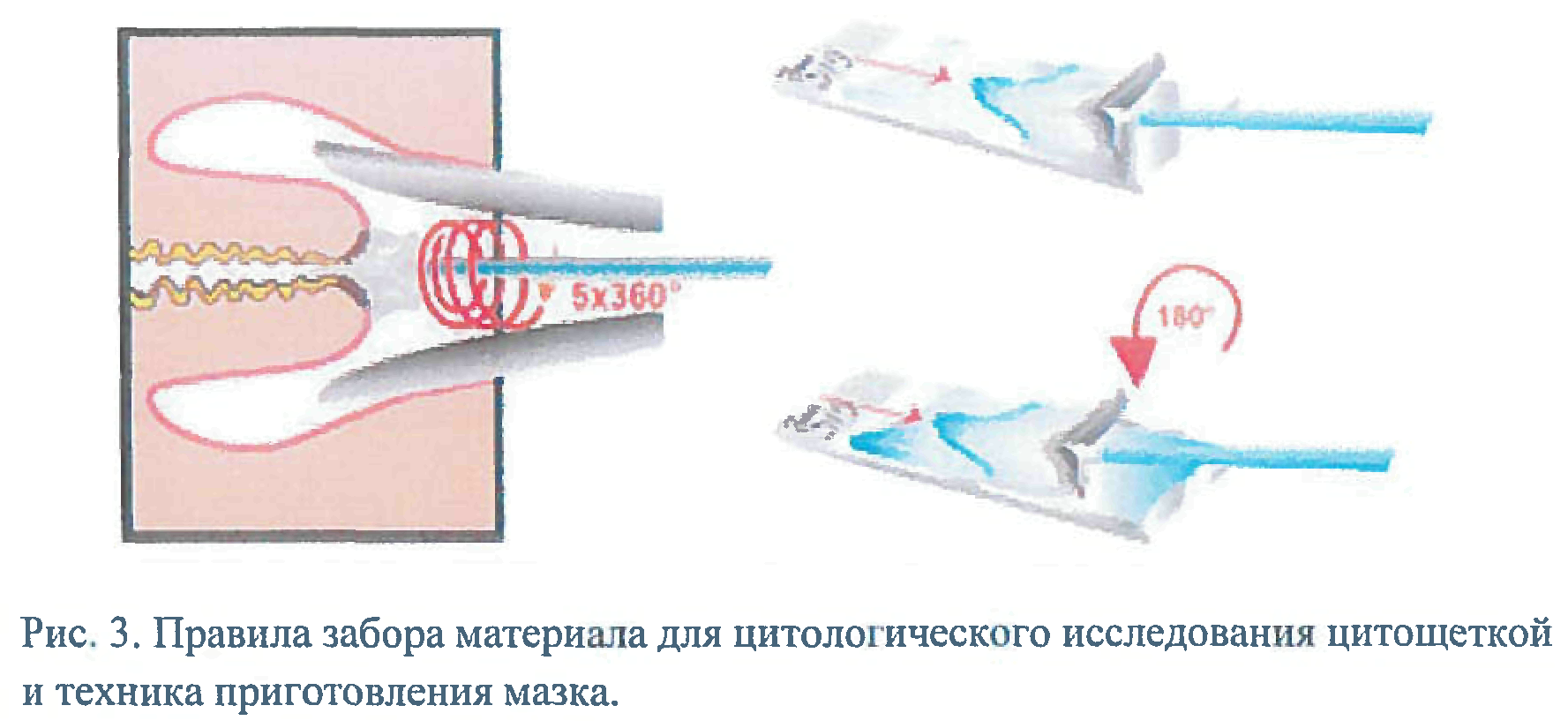 Жидкостная цитология шейки матки и цервикального канала